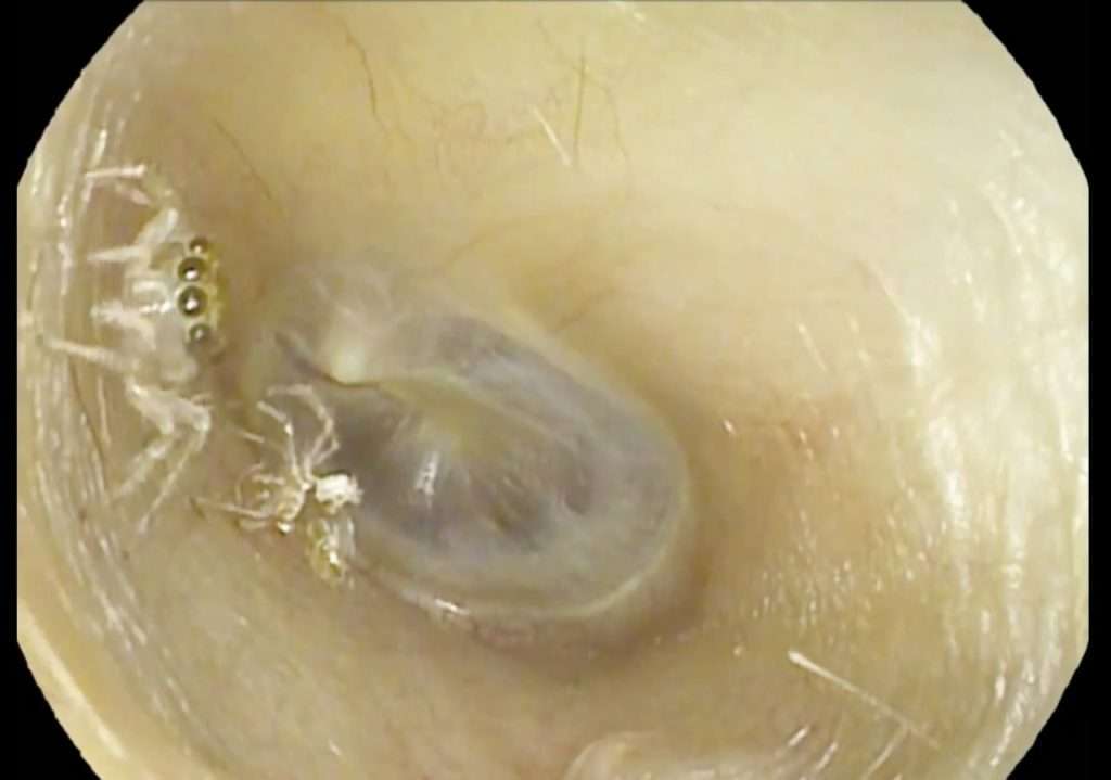 بیرون آوردن عنکبوت از یک گوش زن 64 ساله