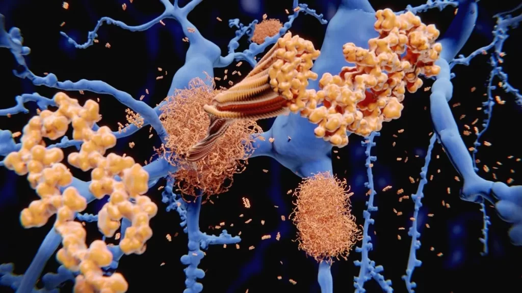 آلزایمر در شرایط خاص از فردی به فرد دیگر منتقل.webp