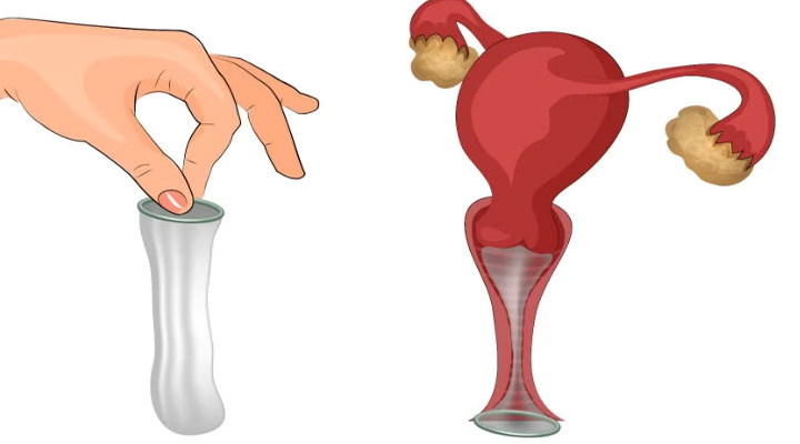 کاندوم زنانه؛ انواع، مزایا، معایب و روش استفاده_آفتاب وطن 7 نحوه استفاده از کاندوم زنانه