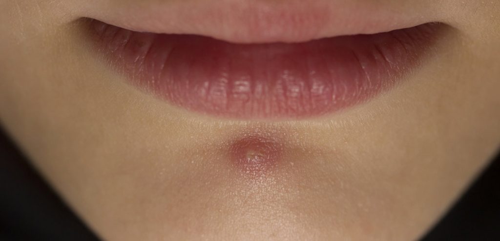 1756541359 ۷ درمان خانگی کورک درمان چیبان در خانه آفتاب وطن