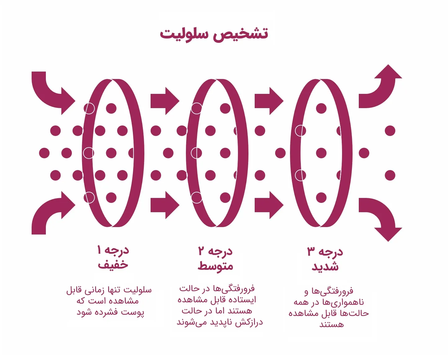 تفاوت لیپیدما و سلولیت: راهنمای تشخیص و درمان_آفتاب وطن 11 اینفوگرافیک درجهبندی شدت سلولیت