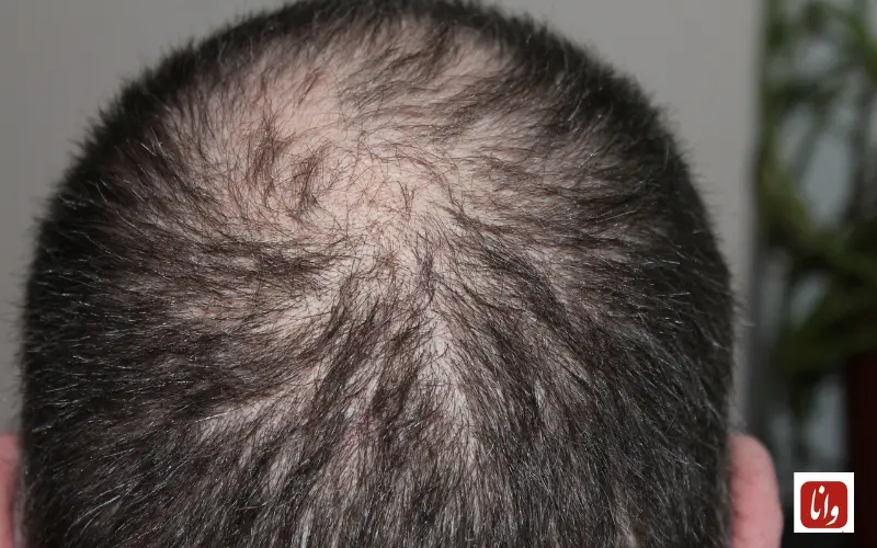 گذر از گذشته به امروز در حوزه کاشت مو