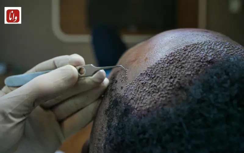 گذر از گذشته به امروز در حوزه کاشت مو